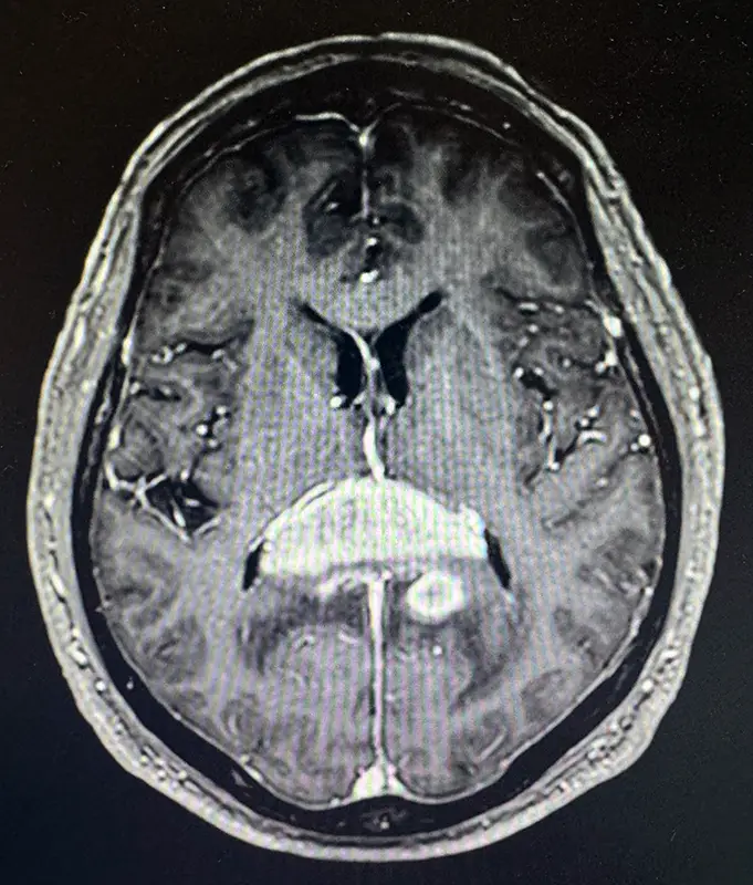 glioblastoma