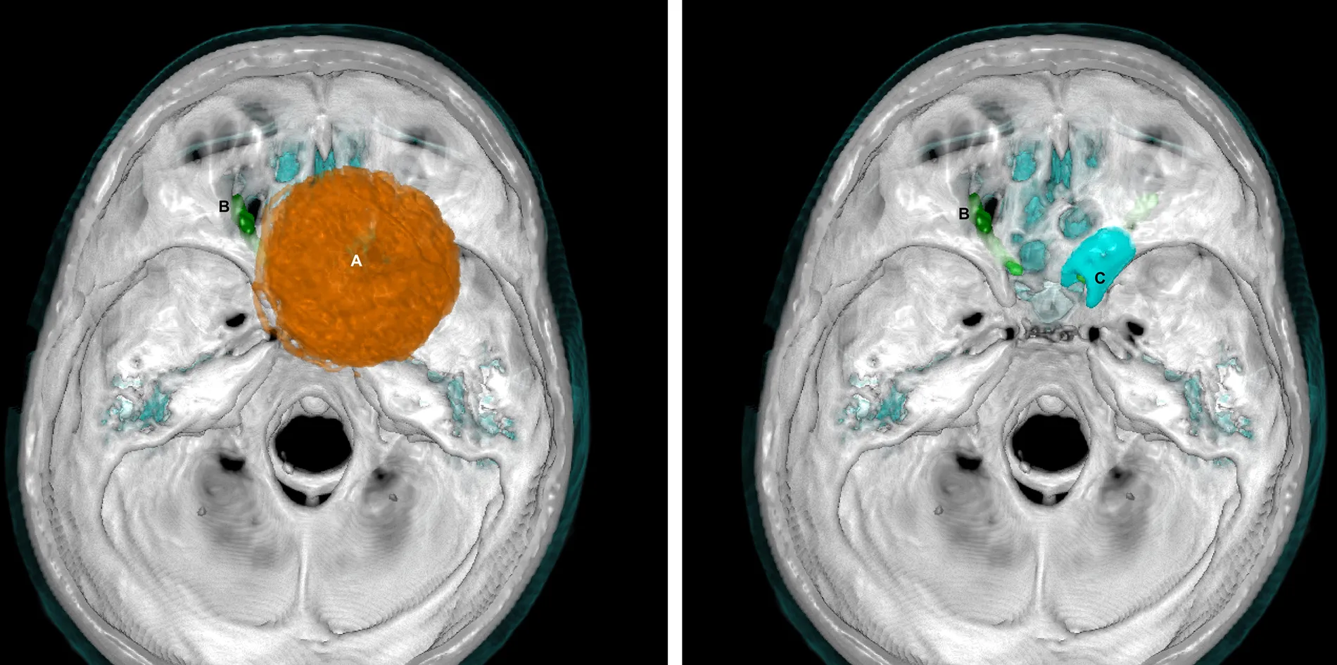 trattamento chirurgico del meningioma