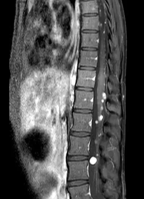 tumore extramidollare